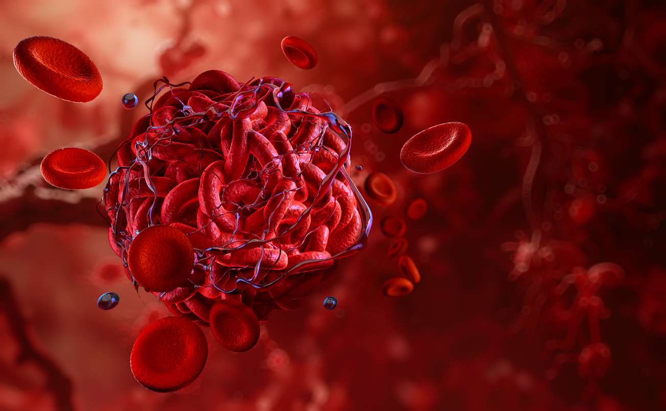 Blood Clot Symptoms: How to Recognize The Warning Signs